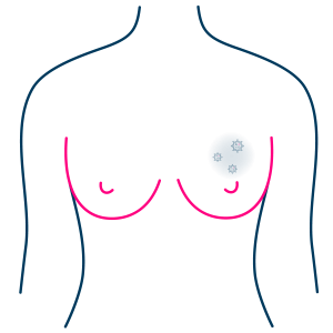 Breast PreCancer