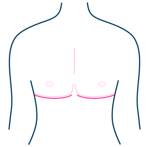 Double Incision Mastectomy Scar-01