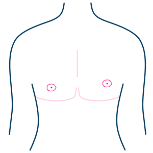 FreeNippleGraft - Asymet-01