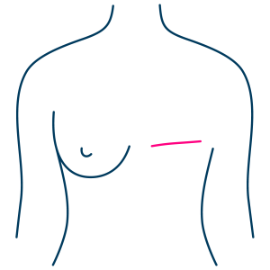 Traditional Breast Surgery
