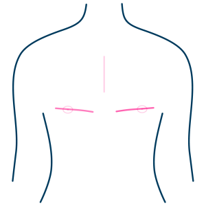High incision (Fishmouth)