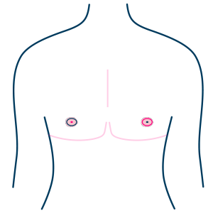 Free Nipple Graft - Complication - Patchy Necrosis