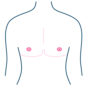 Free Nipple Graft - Hypertrophic Scar