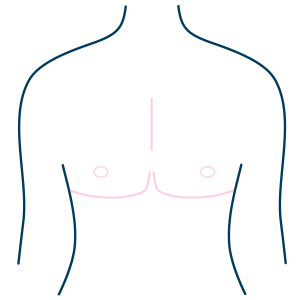 Loss of nipple projection (height)